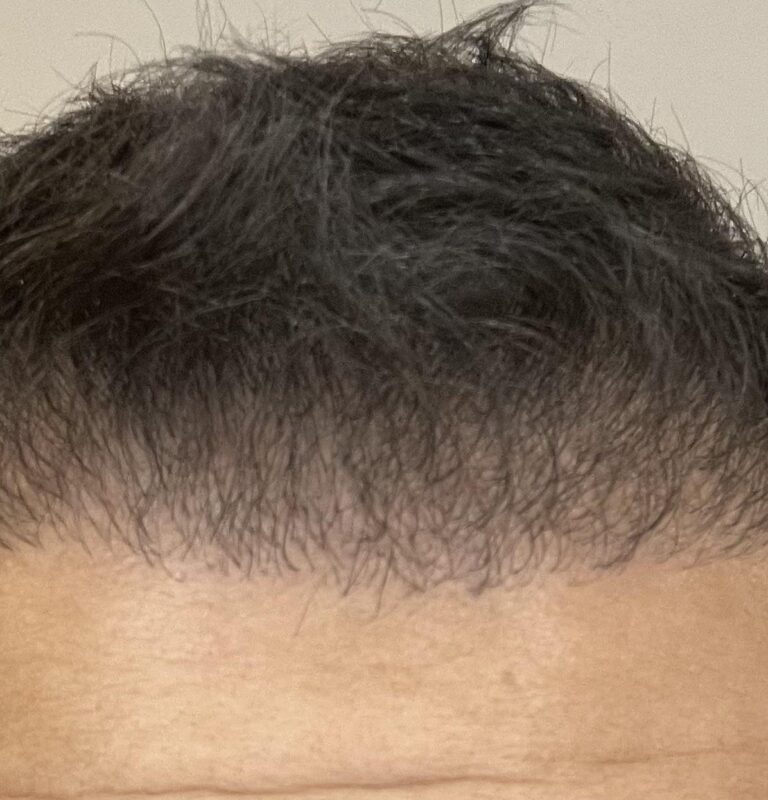 Sessioni di Ritocco per il Trapianto di Capelli