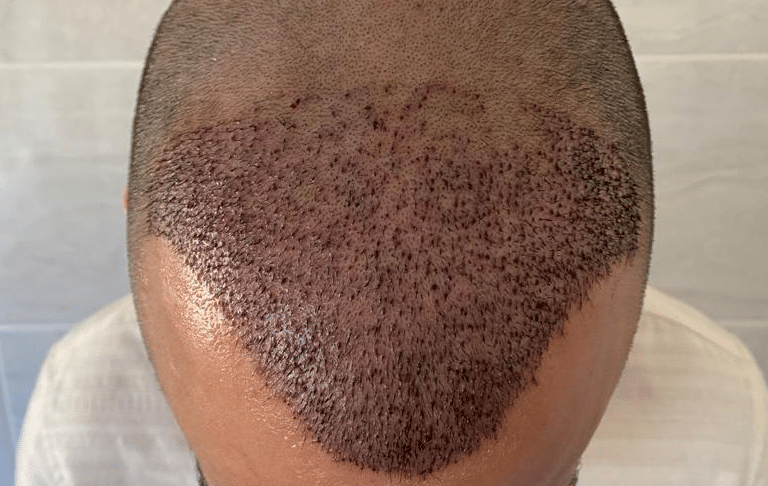 danneggiare un trapianto di capelli